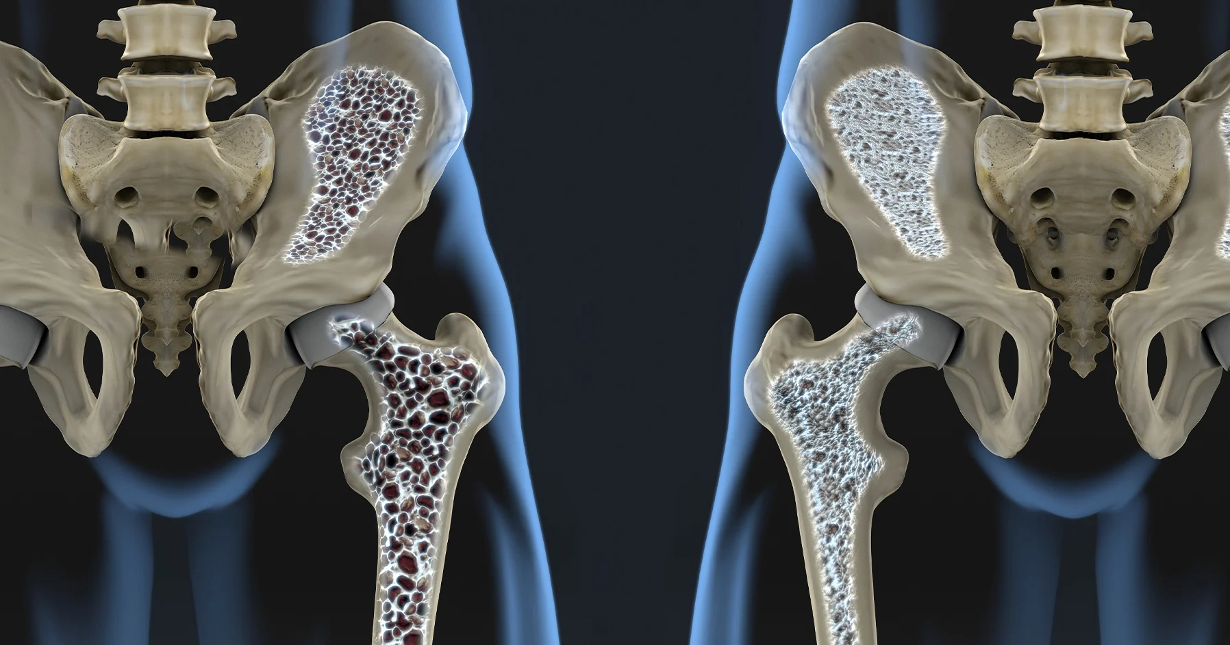 Illustration comparing healthy bone density with osteoporotic bone in the hip and femur