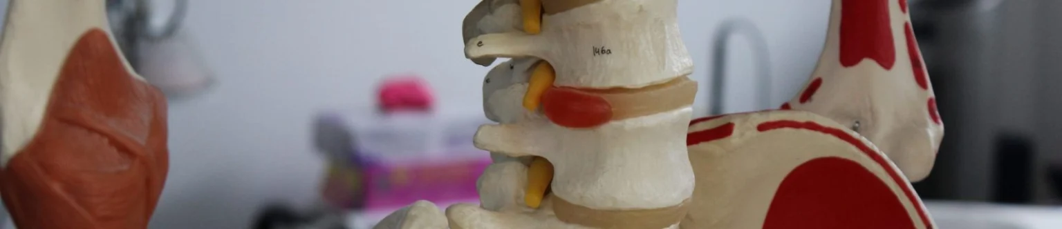 Close-up of a lumbar spine model showing a bulging intervertebral disc at the nerve root