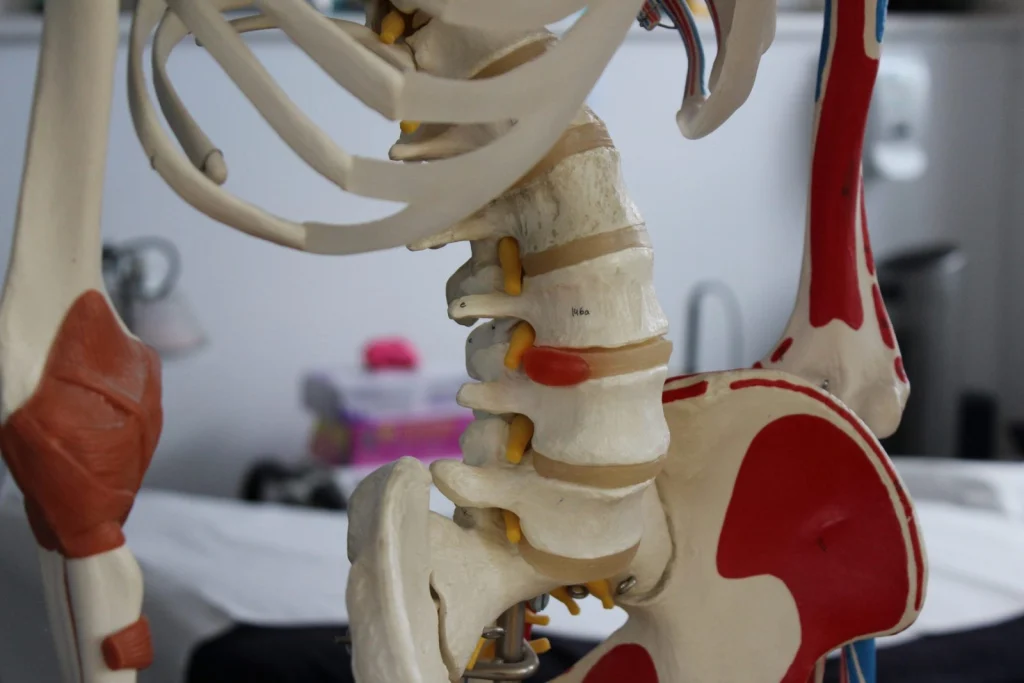 Lumbar spine model with one intervertebral disc highlighted to show a disc bulge