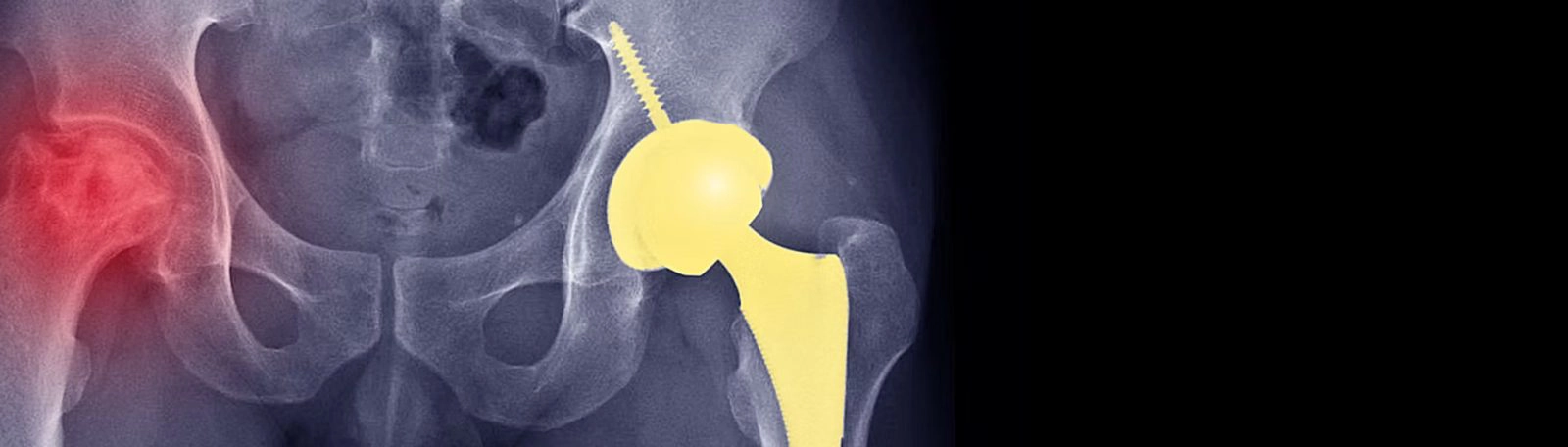 X-ray of a total hip replacement showing the prosthetic stem and cup in place